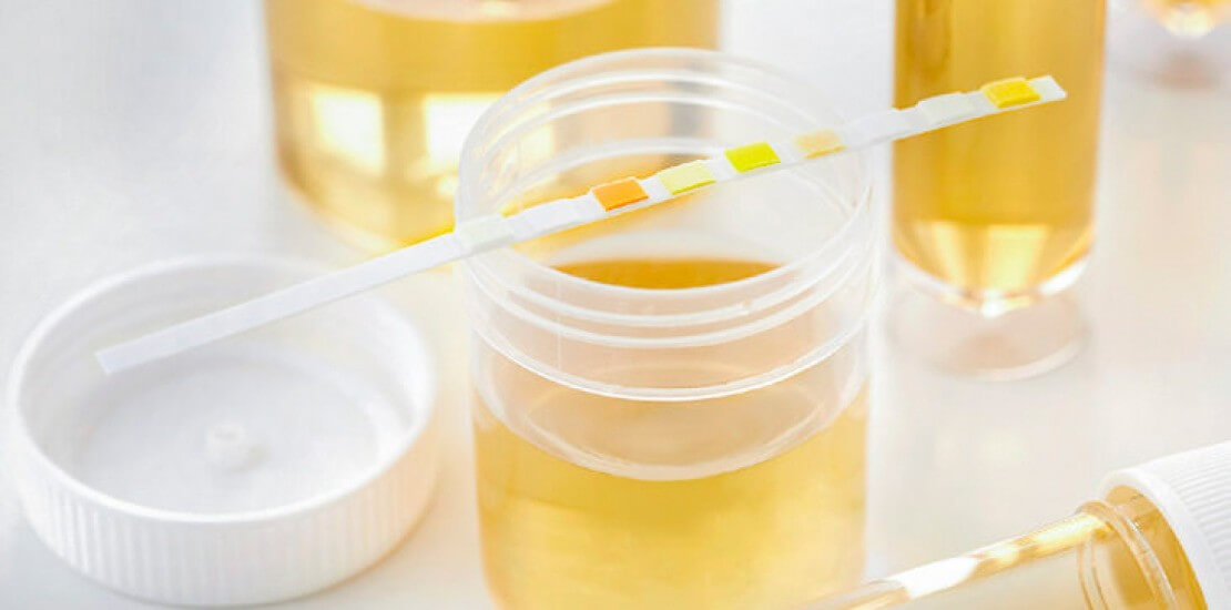 Лабораторні аналізи сечі та крові