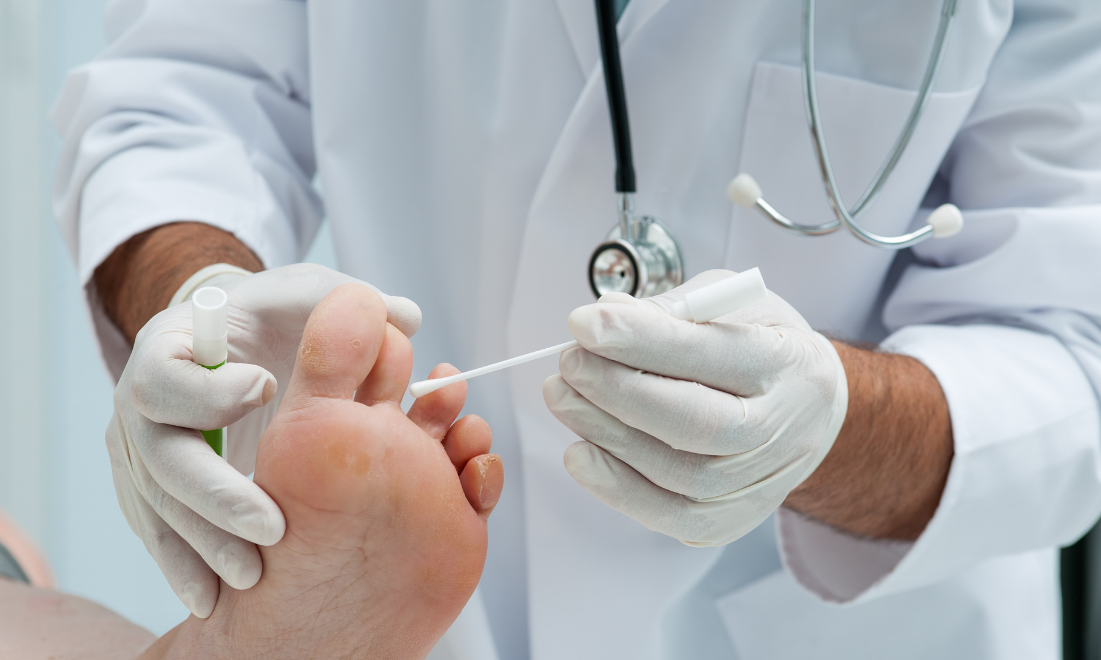 Лікування грибка нігтів