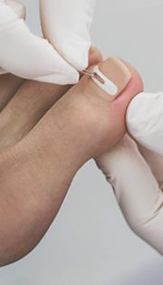 Лікування врослого нігтя